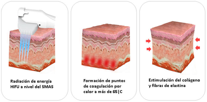 ULTRASKIN---Generalidades-FOTO-3